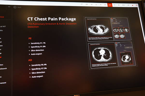 肺塞栓や大動脈解離を自動検出する「Chest Pain Package」（日本国内未展開）