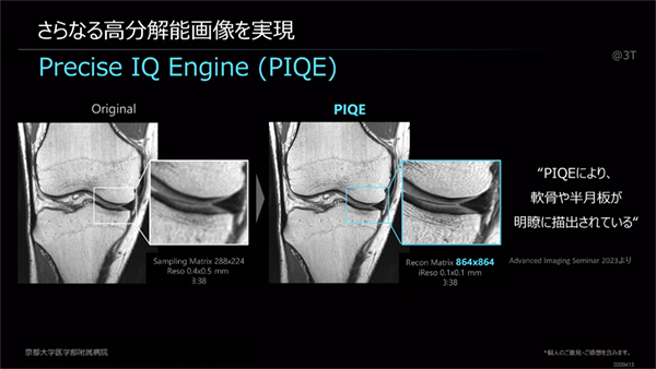 PIQEにより膝関節では軟骨や半月板も明瞭化