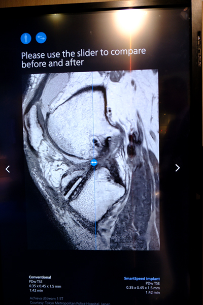 高速イメージング「SmartSpeed」を用いた高画質画像（右がSmartSpeed適用）