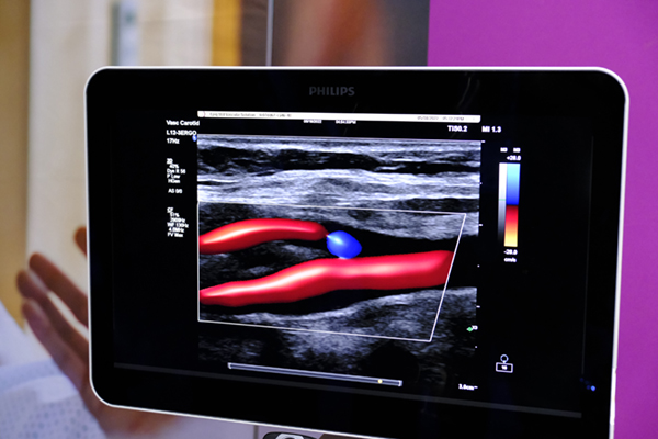 血管をより3Dに近いイメージで表現可能