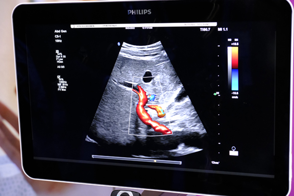 「Flow Viewer」により血管が細い分岐部まで明瞭に描出される