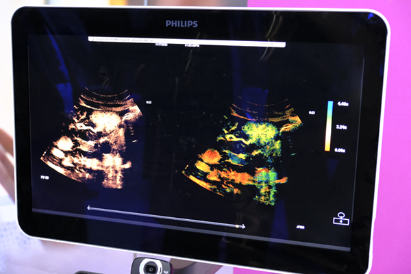 オリジナル画像（左）と「Super-resolution microvascular imaging」（右）。造影剤の移行を色で表現する（青→赤）
