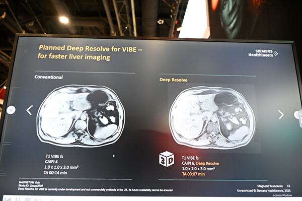 腹部領域の3D撮像における「Deep Resolve」を適応例（写真右）