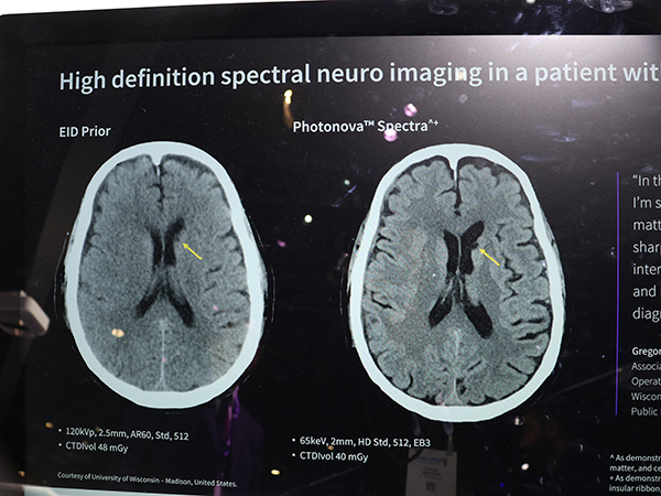 0.12mmの高空間分解能により従来CTよりも病変を明瞭に描出