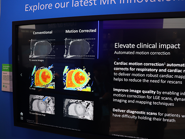 動き補正により定量化の精度が向上