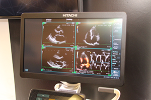 “VFM （Vector Flow Mapping）”により血行動態を可視化（画面右下）