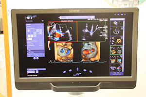 バイプレーンに加え，心室の3D画像表示をリアルタイムで更新する