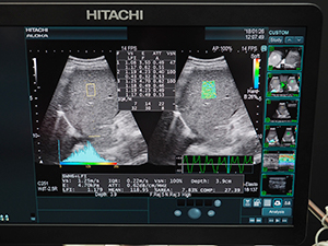 「ARIETTA 850」に新たに搭載された“Combi-Elasto”