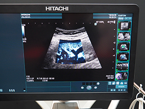 DFIによる腎皮質の小葉間動脈の描出