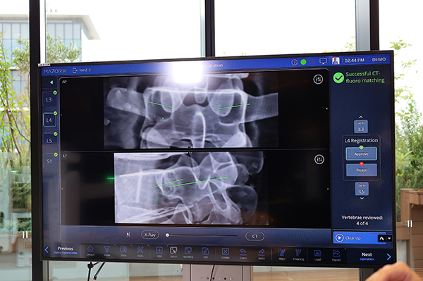 術前計画画像と手術時のX線画像のレジストレーションを椎体ごとに確認し，高精度なナビゲーションを実現