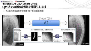 AI技術を用いた椎体計測ソフトウエア「Smart QM」