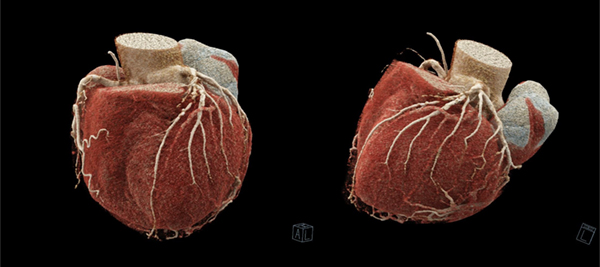 三重大学医学部附属病院で撮影されたNAEOTOM Alphaによる超高精細冠動脈CTA