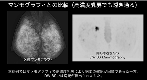 高濃度乳房によりマンモグラフィで病変検出が難しい場合にも，乳がんMRIでは検出可能なケースを紹介