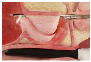 ロボット支援によるウォータージェット切除術