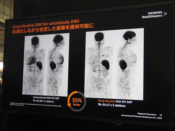 Whole body DWIへのDeep Resolveの適用例 Whole body DWIへのDeep Resolveの適用例